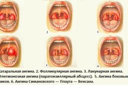 Виды ангин