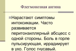 Флегмонозная ангина Флегмонозная ангина