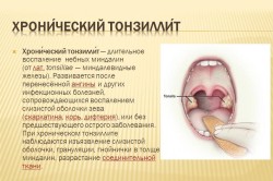Хронический тонзиллит
