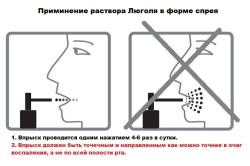 Применение раствора Люголя в форме аэрозоля
