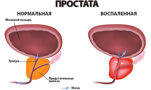 Нормальная и воспаленная простата