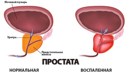 Нормальная и увеличенная простата