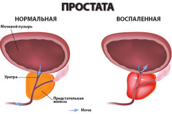 Схема воспаления простаты