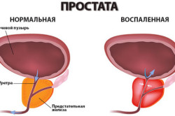 Схема воспаленной простаты