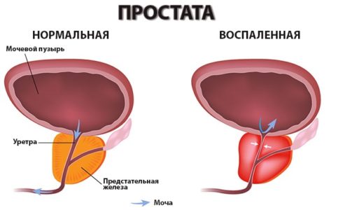 Схема воспаления простаты
