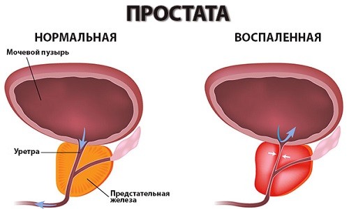 Схема здоровой и воспаленной простаты