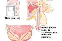 Техника массажа простаты