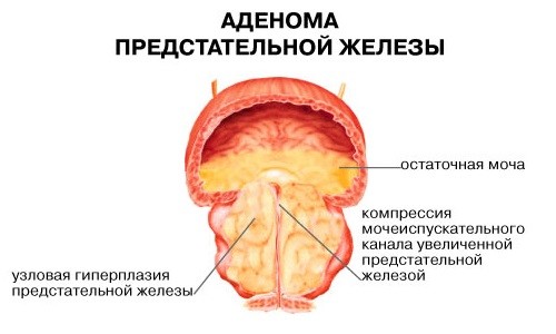Аденома предстательной железы Аденома предстательной железы
