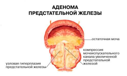Аденома простаты
