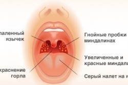 Симптомы гнойной ангины