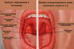 Признаки ангины