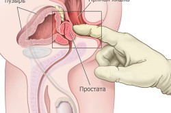 Пальцевой метод диагностики простатита