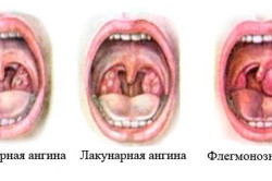 Разновидности ангины