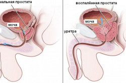 Воспаление простаты