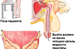 Массаж простаты Массаж простаты