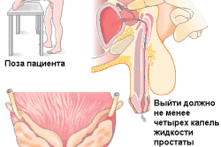 Массаж простаты