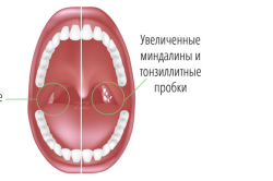 Признаки хронического тонзиллита