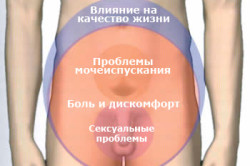 Признаки просатита