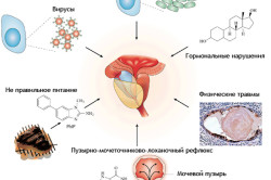 Основные причины простатита