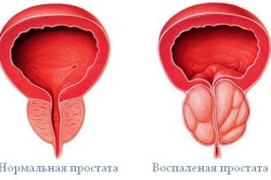 Простатит