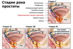 Стадии рака простаты