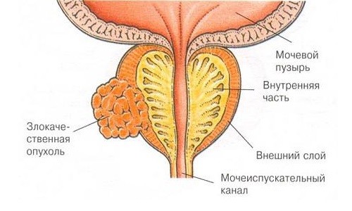 Злокачественная опухоль предстательной железы