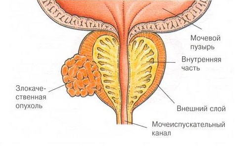 Опухоль предстательной железы