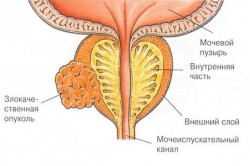 Рак предстательной железы Рак предстательной железы