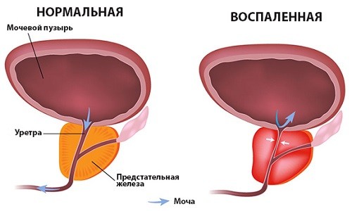Нормальная и воспаленная простата