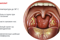 Симптомы тонзиллита