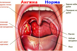 Симптомы ангины