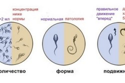 Оценка спермограммы при везикулите