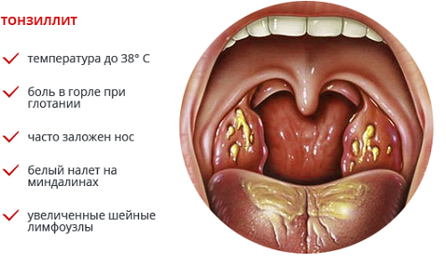Симптомы тонзиллита Симптомы тонзиллита
