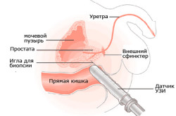УЗИ простаты УЗИ простаты