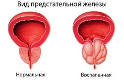 Воспаленная предстательная железа